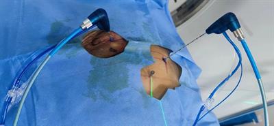 Single ultrasound-guided thoracic paravertebral block with a large volume of anesthetic for microwave ablation of lung tumors